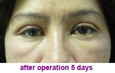 plastic-surgery-blepharoplasty